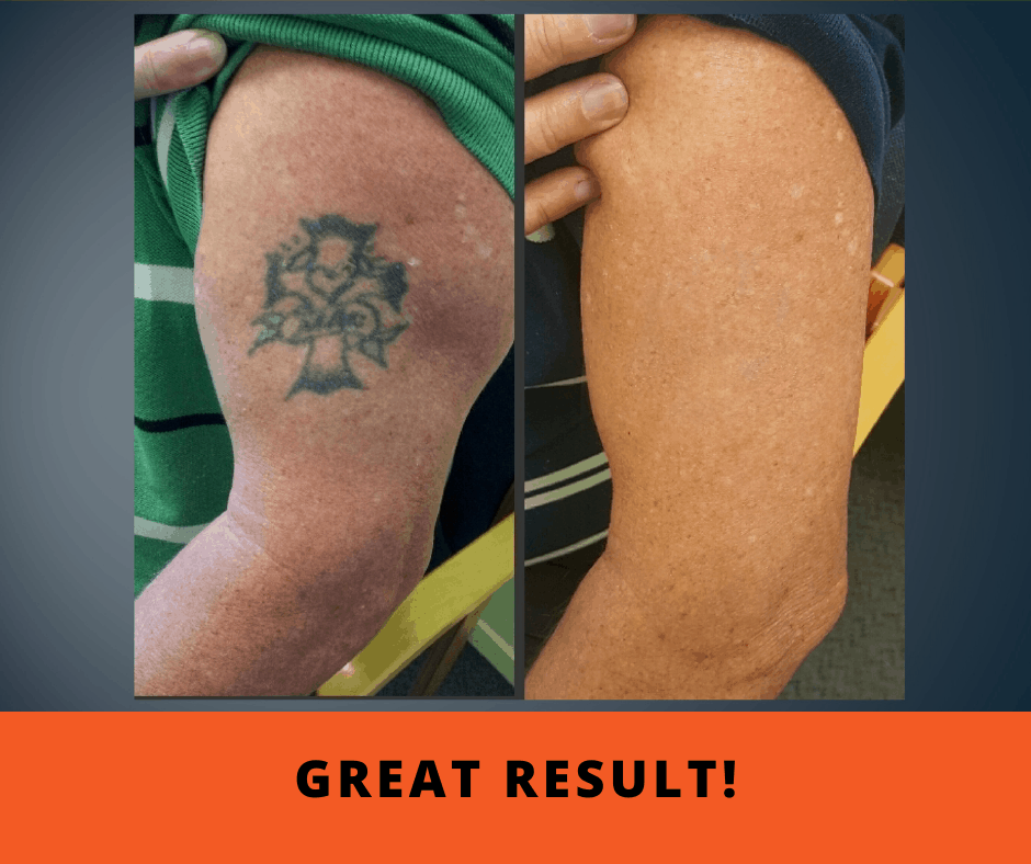 Tattoo Removal Before and After Gallery - Remove Your Tattoo